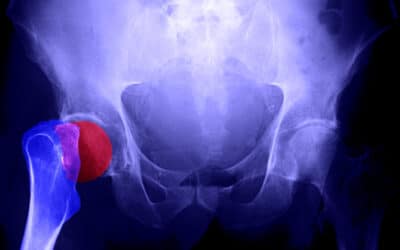 Exposing The Great Osteoporosis Scam
